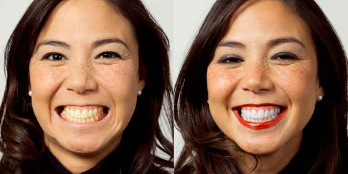 Tooth Whitening Treatments in One Visit. Professional Teeth Whitening